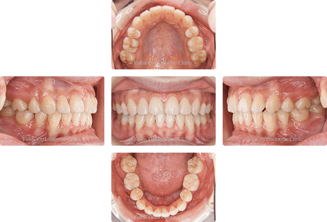 叢生 − 症例1の写真