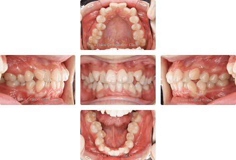 叢生 − 症例1の写真