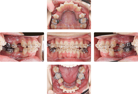 叢生 − 症例1の写真