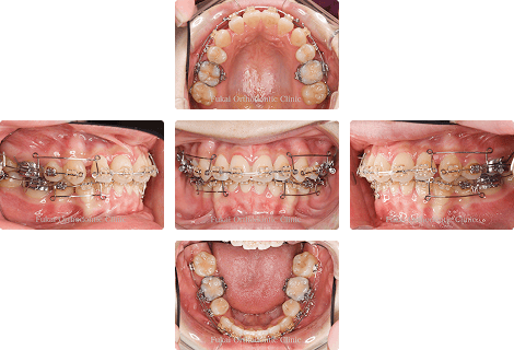 叢生 − 症例1の写真