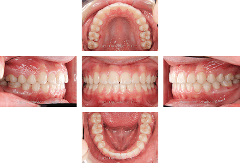 叢生 − 症例2の写真
