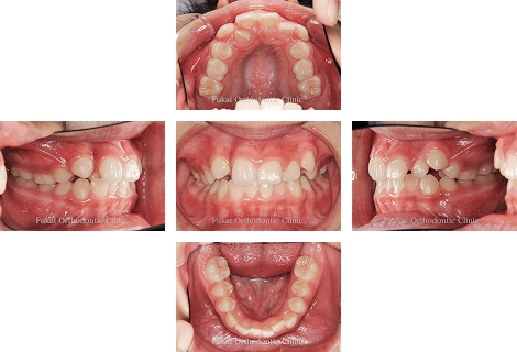 叢生 − 症例2の写真