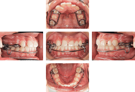 叢生 − 症例2の写真