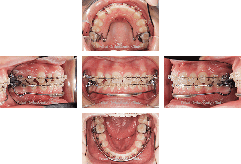 叢生 − 症例2の写真