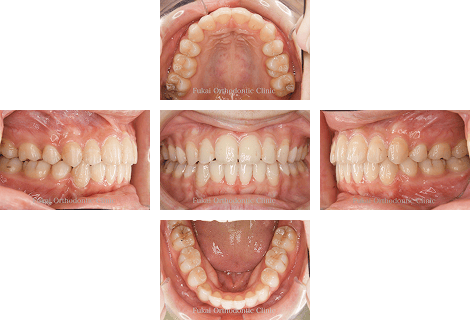 叢生 − 症例3の写真