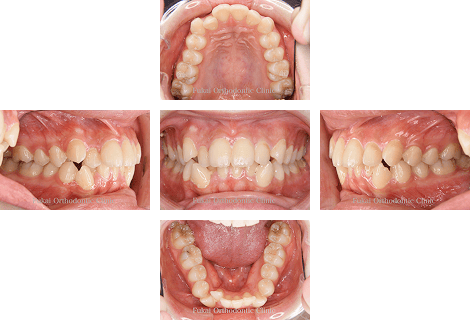 叢生 − 症例3の写真
