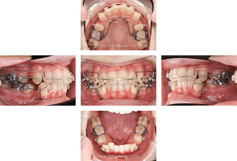 叢生 − 症例3の写真