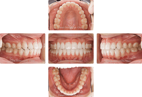 叢生 − 症例3の写真