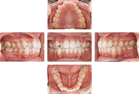叢生 − 症例3の写真