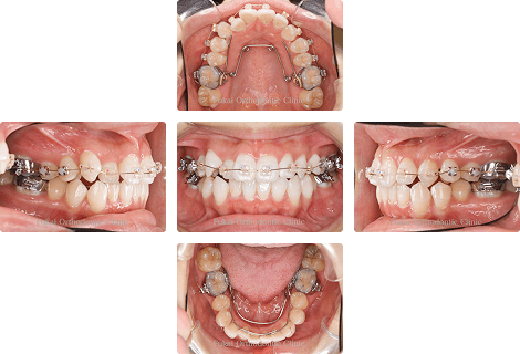 叢生 − 症例3の写真