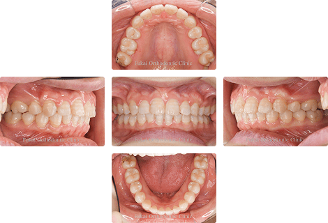 上顎前突 − 症例1の写真