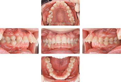 上顎前突 − 症例1の写真