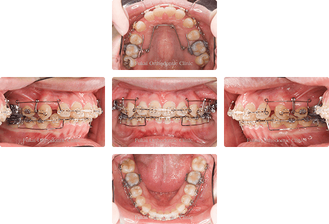 上顎前突 − 症例1の写真