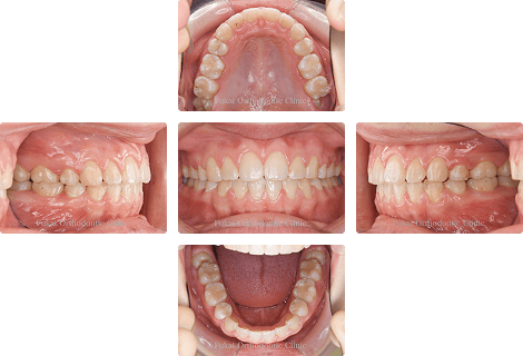 上顎前突 − 症例2の写真