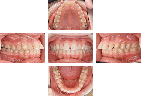 上顎前突 − 症例2の写真