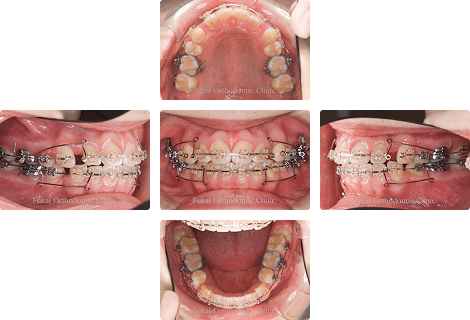上顎前突 − 症例2の写真