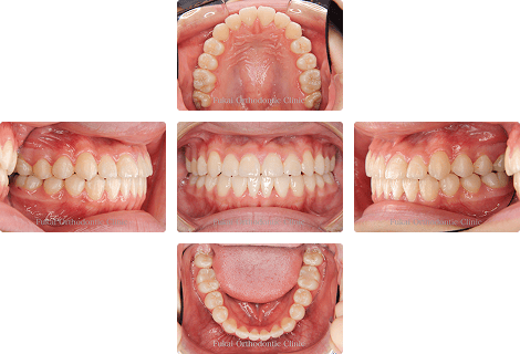 下顎前突 − 症例1の写真