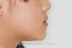 下顎前突 − 症例1の写真