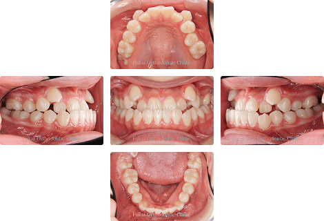 下顎前突 − 症例1の写真