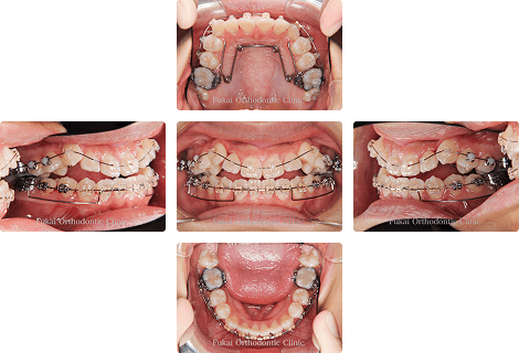 下顎前突 − 症例1の写真