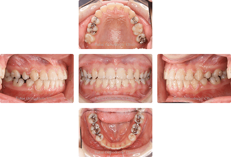 下顎前突 − 症例2の写真