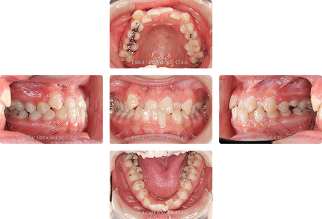 下顎前突 − 症例2の写真