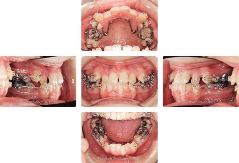 下顎前突 − 症例2の写真