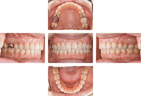 開咬 − 症例1の写真
