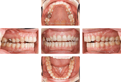 開咬 − 症例1の写真