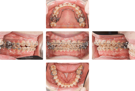 開咬 − 症例1の写真