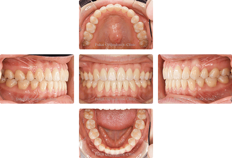 開咬 − 症例1の写真