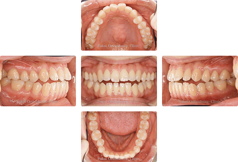 開咬 − 症例1の写真