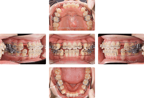 開咬 − 症例1の写真