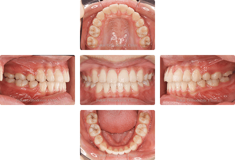 上下顎前突 − 症例1の写真