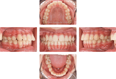 上下顎前突 − 症例1の写真