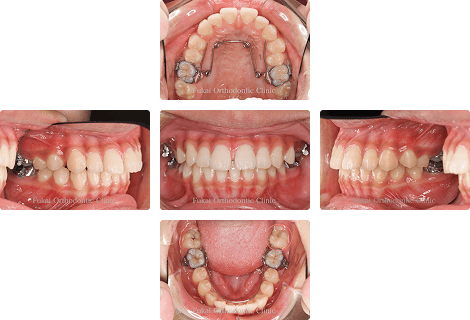 上下顎前突 − 症例1の写真