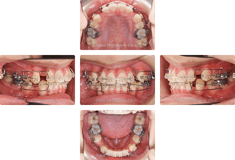 上下顎前突 − 症例1の写真