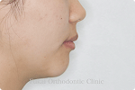 上下顎前突 − 症例2の写真