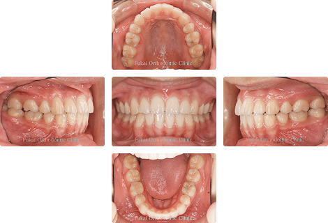 上下顎前突 − 症例2の写真
