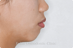上下顎前突 − 症例2の写真