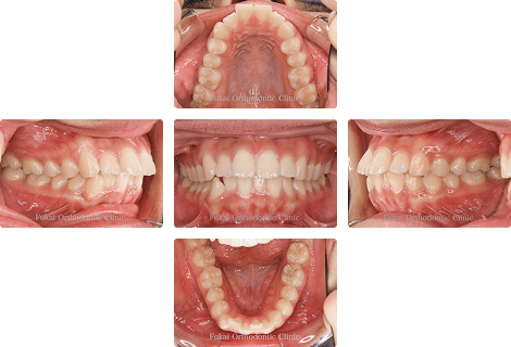 上下顎前突 − 症例2の写真
