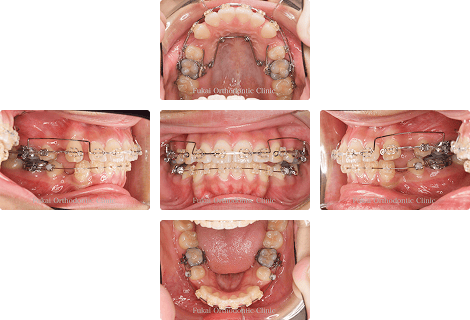 上下顎前突 − 症例2の写真