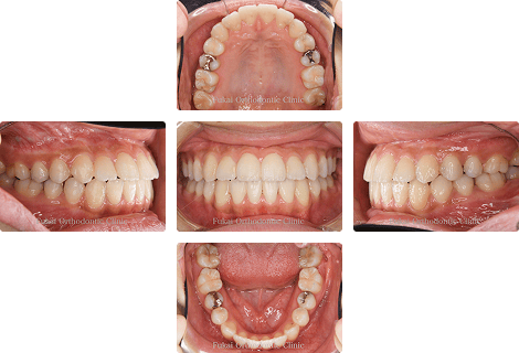外科的矯正治療 − 症例1の写真