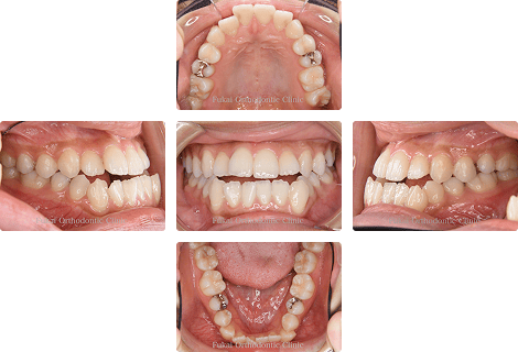 外科的矯正治療 − 症例1の写真