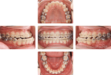 外科的矯正治療 − 症例1の写真