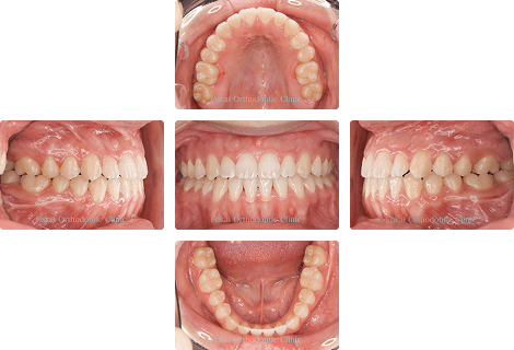 外科的矯正治療 − 症例2の写真