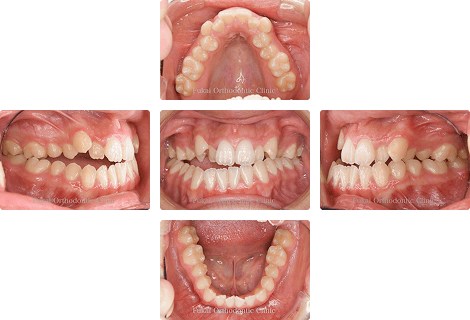 外科的矯正治療 − 症例2の写真
