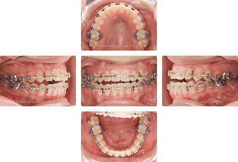 外科的矯正治療 − 症例2の写真