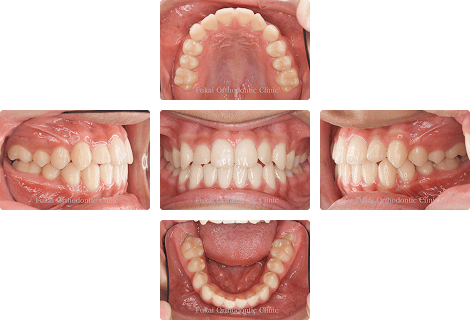 ガタガタ(叢生)− 症例1の写真
