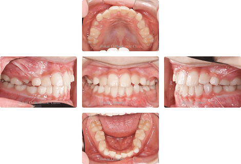 ガタガタ(叢生)− 症例1の写真
